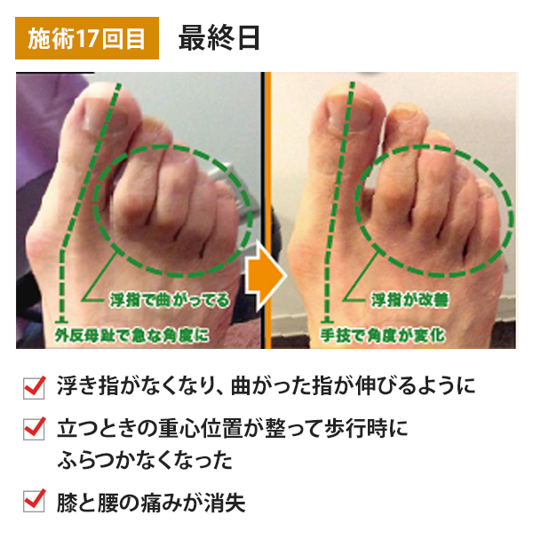 施術17回目